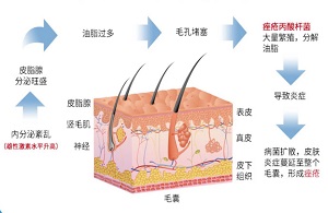 “戰(zhàn)痘”記之奧絡(luò)乳膏可以治痤瘡嗎？