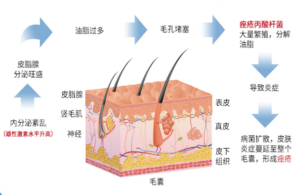 長不完的痘痘，上不完的火，上火長痤瘡疼怎么快速解決？