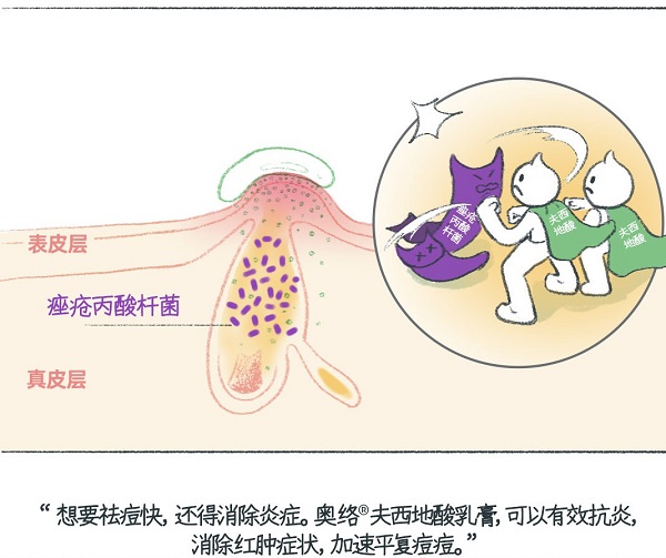 對于痤瘡該使用什么軟膏？不妨試試它