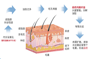 小作精痘痘發(fā)炎紅腫涂藥膏能消嗎