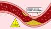 頸動脈斑塊是什么原因造成的