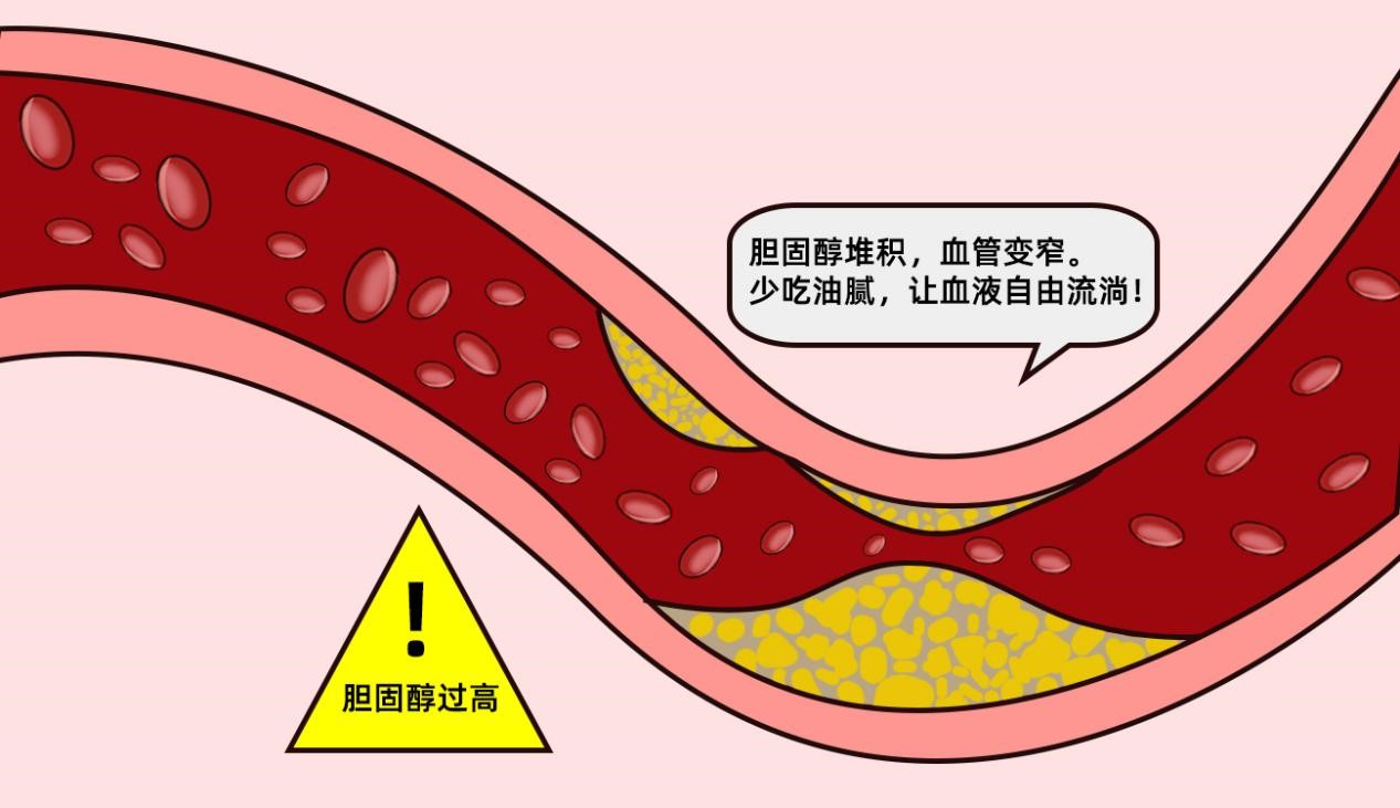 頸動脈硬化斑塊怎么辦