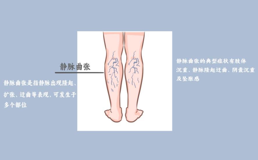 小腿靜脈曲張穿彈力襪有用嗎